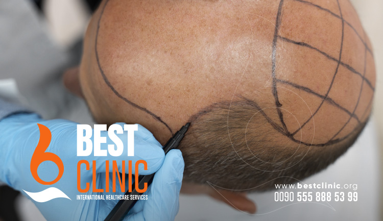 Hair Transplantation In Turkey